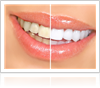 Teeth Whitening Options