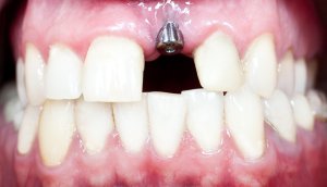 Dental Implants in St Louis