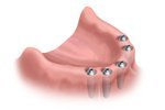Replacement teeth implants St. Louis