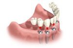 Tooth implant bridge