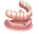 Removable implant anchored overdenture