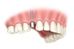 installing a tooth implant