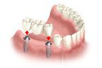 Teeth replacement bridge