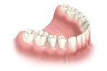 Multiple teeth implants